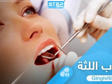 5 من افضل ادوية علاج التهاب اللثة المتعارف عليها إليك بها