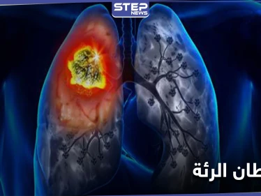 أورام غير متوقعة قد تكون دليلًا على الإصابة بـ سرطان الرئة
