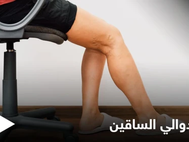 تعرف على أهم الوصفات الطبيعية لعلاج دوالي الساقين