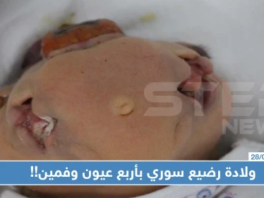 حالة نادرة: ولادة رضيع سوري بأربع عيون وفمين!!