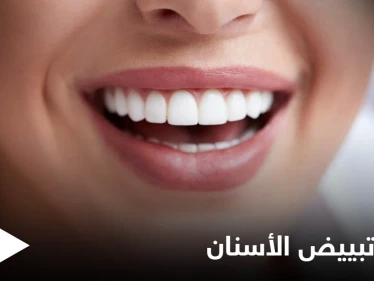 تبييض الأسنان في المنزل وأبرز أنواعه الطبية