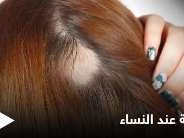 الثعلبة عند النساء.. تعرف على الأسباب وطرق العلاج