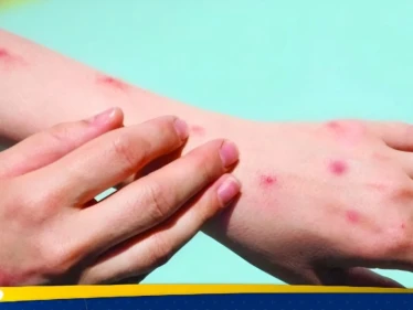 الصحة العالمية ترفع حالة الطوارئ بشأن جدري القرود