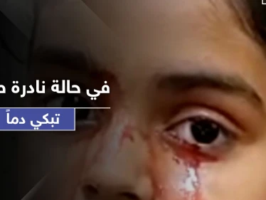 طفلة تبكي دماً بدل الدمع.. حالة طبية نادرة تربك الأطباء وهذه أسبابها