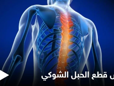 تعرف على أنواع وأعراض قطع الحبل الشوكي وطرق العلاج