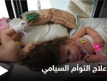 في حالة طبية نادرة.. نجاح علاج التوأم السيامي التركي وقدرتهما على المشي ومصادر تكشف التفاصيل