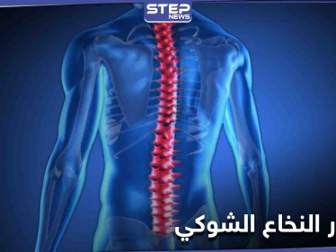 تعرف على مرض ضمور النخاع الشوكي أسبابه ومراحل خطورته على حياة الإنسان