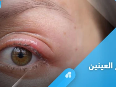 هل تعاني من تورم العينين.. إليك أهم الأسباب وطرق العلاج في المنزل