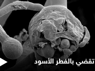 وفاة أول سيدة عربية يشتبه بإصابتها بـ الفطر الأسود