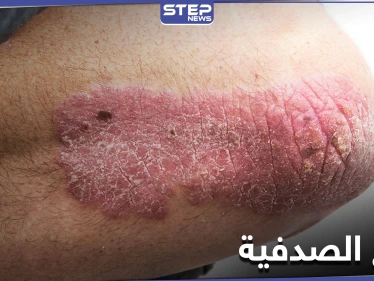أثر النظام الغذائي على علاج الصدفية.. أنواعها وطرق الوقاية منها