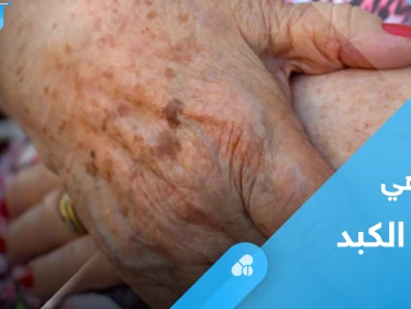 بقع الكبد.. ما هي ومتى تستدعي القلق