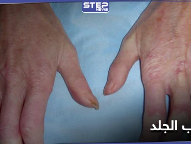 تعرف على مرض تصلب الجلد وآثاره على الأعضاء الداخلية بما فيها الكلى والرئتين