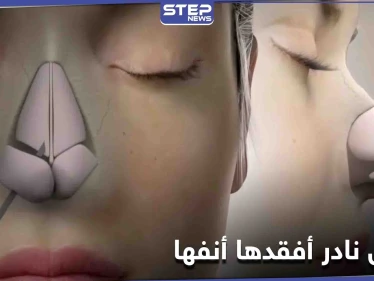 مرض نادر أصابها فأصبحت بلا أنف والأطباء يكشفون الأعضاء المعرضة لهذا التلف