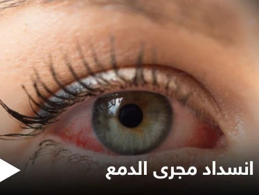 علاج انسداد مجرى الدمع لدى البالغين وأهم المعلومات عنه