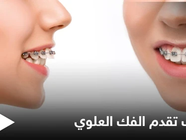هل هي الوراثة.. الكشف عن أسباب تقدم الفك العلوي وأعراضه وطرق العلاج