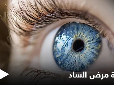 أكثر أمراض العين خبثاً.. ما هو مرض الساد وماهي أسبابه إليك التفاصيل
