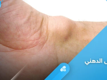الكيس الدهني.. هل هو خطير وأبرز أعراضه وعلاجه إليك أهم المعلومات