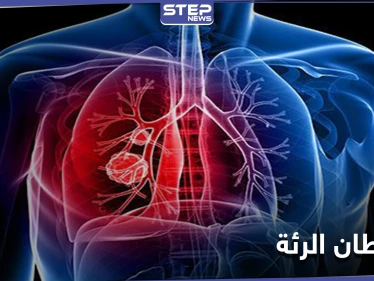 علامة تظهر في منطقة العين تدلُّ على الإصابة بـ سرطان الرئة.. إليك التفاصيل