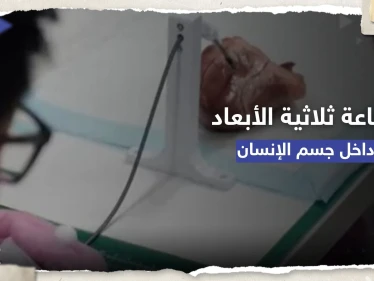 إنجاز علمي.. طباعة ثلاثية الأبعاد داخل جسم الإنسان