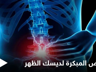 من أمراض العصر.. ديسك الظهر إليك أعراضه المبكرة وطرق علاجه