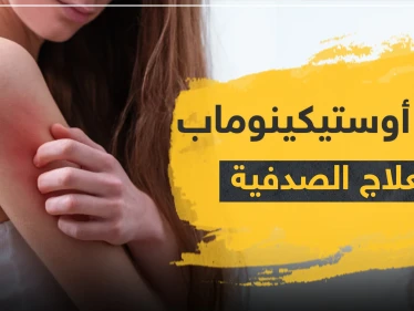 دواء أوستيكينوماب لعلاج الصدفية