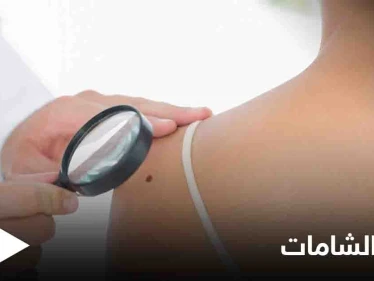 ماهي الشامة وهل لها علاقة بسرطان الجلد تعرف على أنواعها