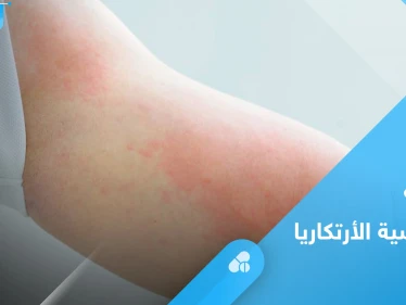 ما هي حساسية الأرتكاريا.. تعرف على أسبابها وأبرز طرق العلاج
