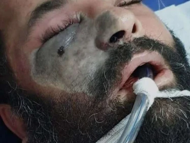 مصر تصدر بياناً بشأن تطورات الإصابة بـ الفطر الأسود.. ورئيس لجنة الصحة يناشد المواطنين