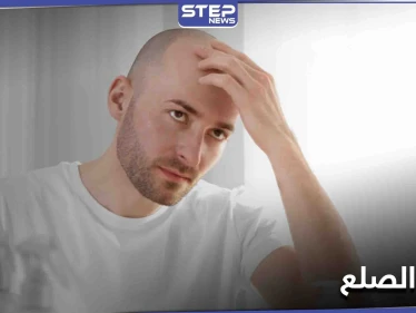 تمهيداً لعلاج الصلع.. العلماء يكشفون السبب الذي يثبّط نشاط بصيلات الشعر