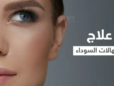 علاج الهالات السوداء "ازرقاق تحت العين" في المنزل وبطرق طبية إليك أهم المعلومات