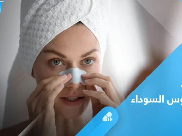 الرؤوس السوداء.. أسباب ظهورها والأنواع وطرق العلاج