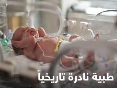 بحالة طبية نادرة للغاية.. ولادة طفل برازيلي بذيل بشري حقيقي مع كرة بنهايته (صور)