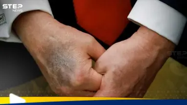 شاهد|| كدمات داكنة على يد ترامب تثير المخاوف مجدداً حول صحته: أحدث الأخبار