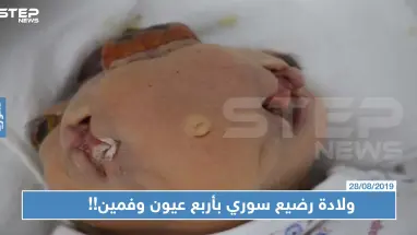حالة نادرة: ولادة رضيع سوري بأربع عيون وفمين!!