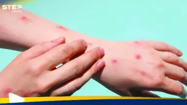 الصحة العالمية ترفع حالة الطوارئ بشأن جدري القرود: أحدث الأخبار