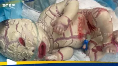 في حالة نادرة.. ولادة طفل عراقي بقشر سمكة (صورة): أحدث الأخبار