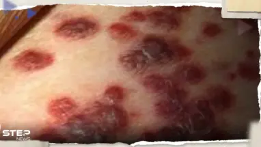 أمريكا تُحذّر من بكتيريا خطيرة آكلة للحوم.. إليك أبرز أعراضها