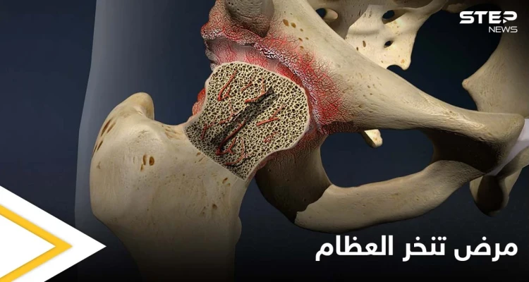ما هو تنخر العظام.. وماهي أنواعه وأهم الأسباب المؤدية إليه