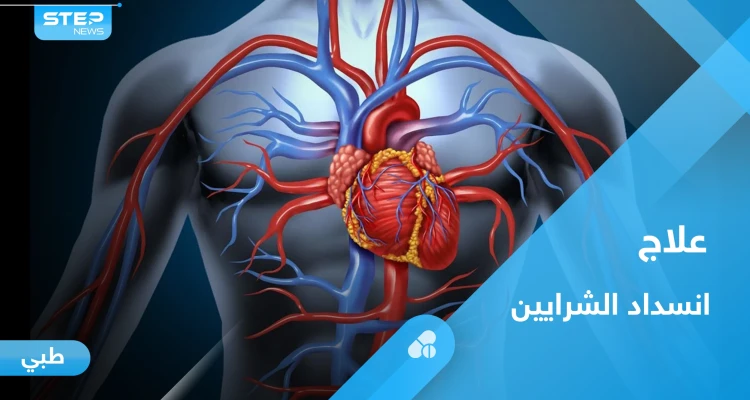 علاج انسداد الشرايين والأوعية الدموية بوسائل طبيعية