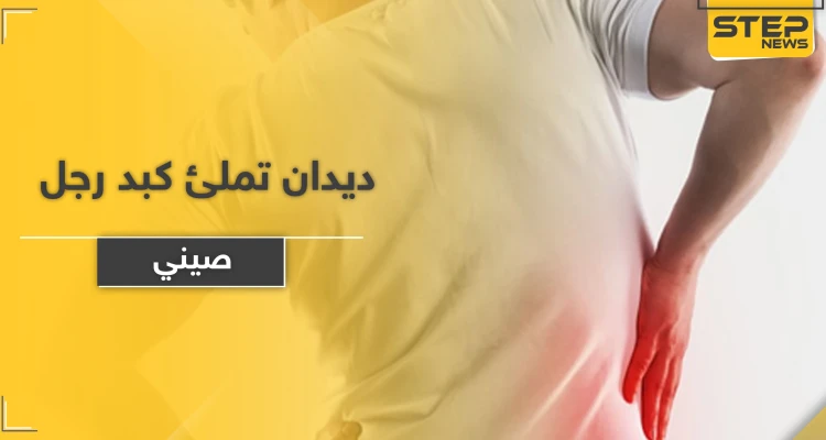 بالصور|| ديدان تملئ كبد رجل صيني.. والأطباء يضطرون لإستئصال جزء كبير منه ويوضحون الأسباب