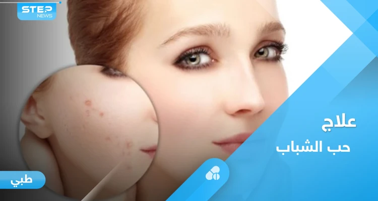 وصفات طبيعية لعلاج حب الشباب تعرف عليها