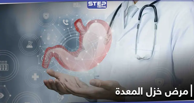 ما هو مرض خزل المعدة وكيف يعطل عمل الجهاز الهضمي وأسبابه وطرق العلاج: أخبار
