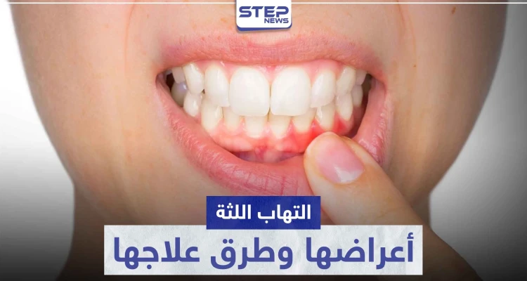 تعرّف على أكثر من كبسول لعلاج التهاب اللثة و ما هي أسبابها وأعراضها