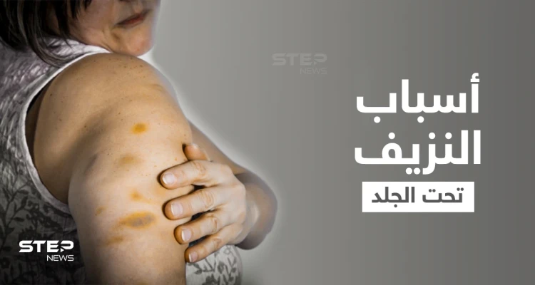 نزيف تحت الجلد... علامات أرجوانية أشبه بالكدمات على الجسم ما هي أسبابها وطرق علاجها