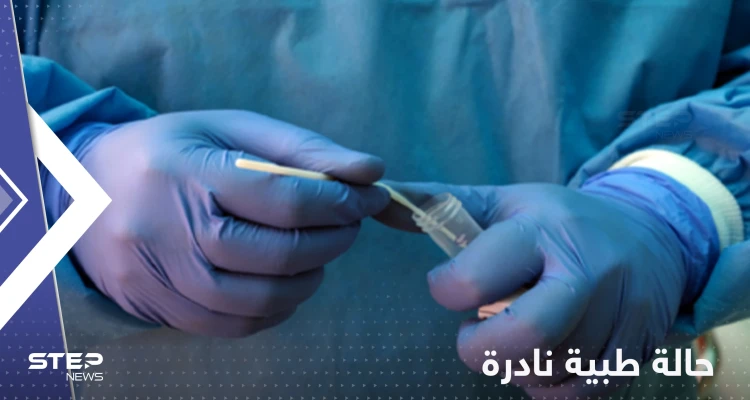 الإعلان لأول مرة عن شخص مصاب بكورونا والإيدز وجدري القردة معاً