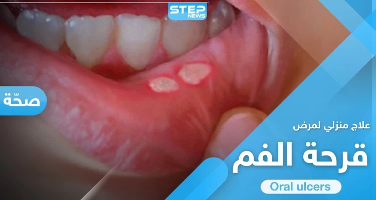 علاج قرحة الفم في المنزل.. إليك الطريقة و7 نصائح هامة