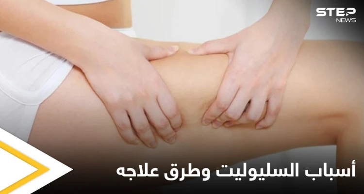 ماهو السليوليت ومأ أسبابه وإصابته للنساء بشكل أكبر إليك أهم المعلومات