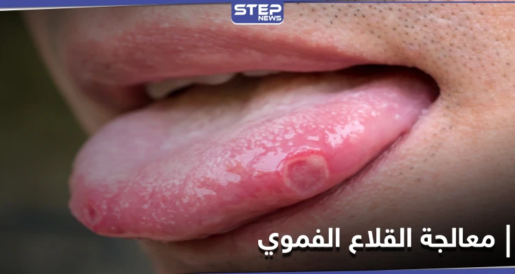 علاجات منزلية مذهلة للتخلص من القلاع الفموي بشكل طبيعي.. إليك 4 طرق
