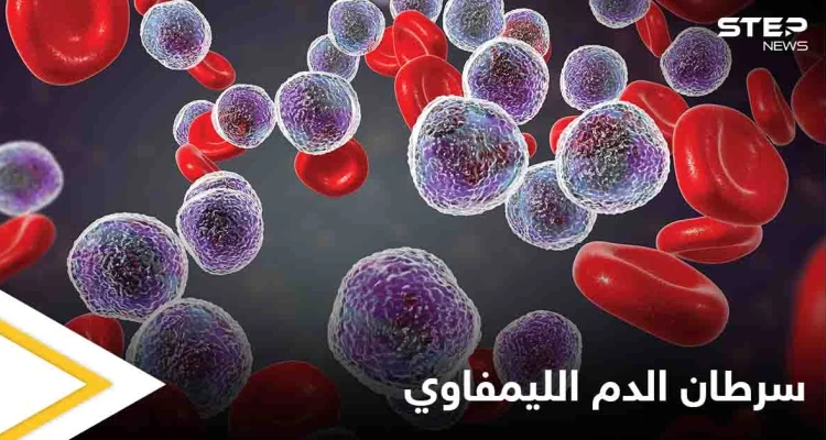 ما هو سرطان الدم الليمفاوي وكيف تظهر أعراضه على المريض إليك أهم المعلومات