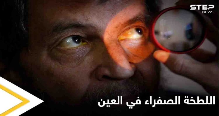 تعرف على أسباب ظهور اللطخة الصفراء في العين وعلاجاتها